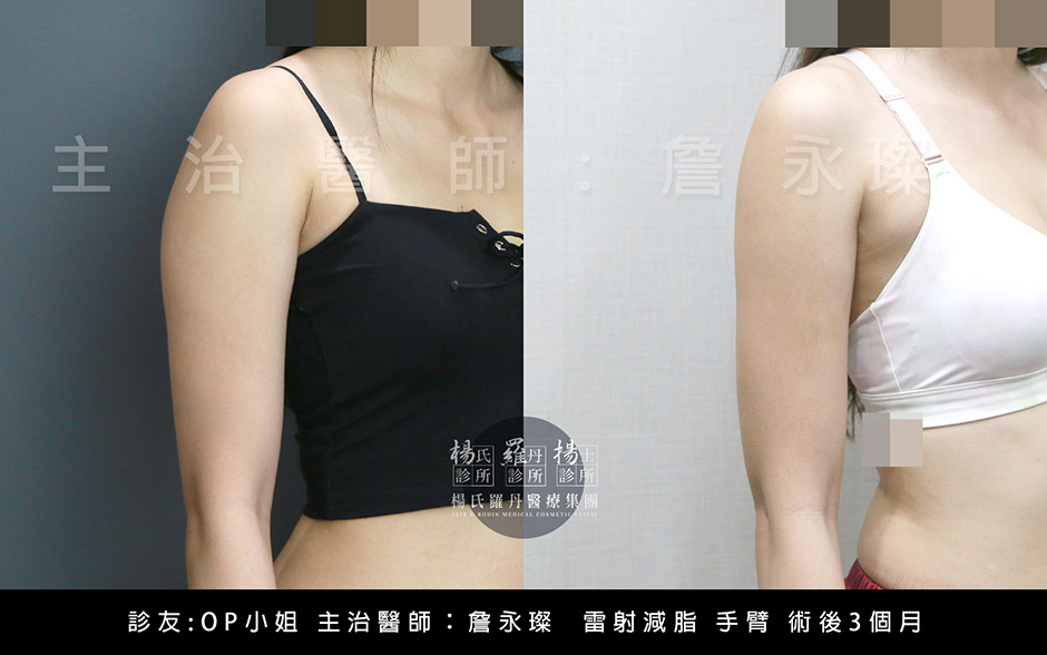 雷射減脂,楊氏羅丹 手臂 蝴蝶袖 瘦手臂